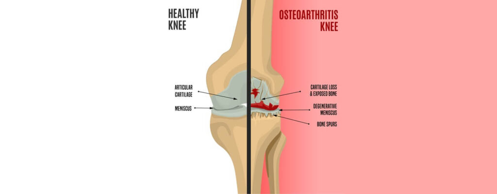 Physical Therapy for Knee Osteoarthritis