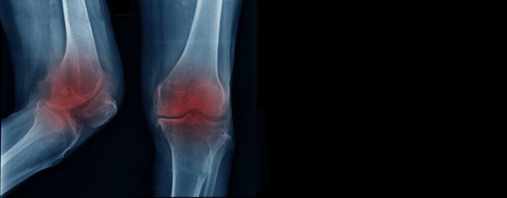 Understanding Physical Therapy Treatment for Different Types of Arthritis